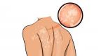 النخالية المبرقشة.. الأسباب والعلاج (إنفوجراف)