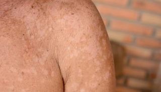 آثار مرض النخالية المبرقشة