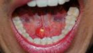 الحصوة اللعابية.. الأسباب وسبل الوقاية