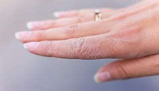 نقص الزنك يؤدي إلى جفاف الجلد