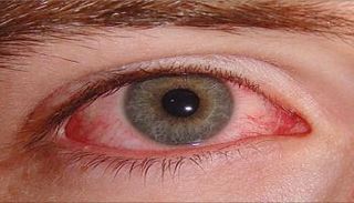 الاحمرار من أبرز أعراض ارتفاع ضغط العين