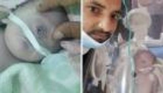 ولادة طفل بعين واحدة في اليمن