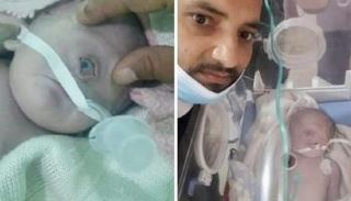 الطفل ذو العين الواحدة