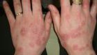 علاج الإكزيما.. وصفة طبيعية قبل زيارة الطبيب