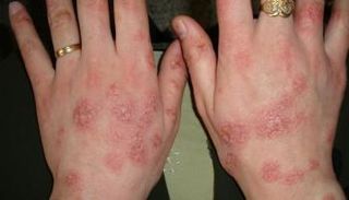 الإكزيما تُحيل حياة المريض إلى جحيم