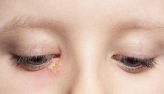 هربس العيون