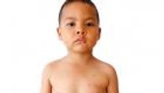 حمو النيل عند الأطفال.. أسباب وأعراض (إنفوجراف)