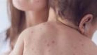 "الصحة العالمية" تحذر من تفشي الحصبة.. 7 نصائح للوقاية