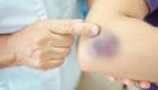 البقع الزرقاء.. جرس إنذار لمشاكل صحية أخطرها السرطان