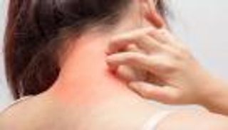 حساسية الهستامين.. أعراضها وطرق العلاج