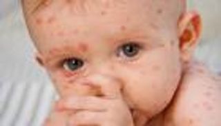 جدري القرود يواصل التفشي.. والصحة العالمية تدق ناقوس الخطر