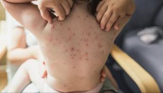 ألمانيا تسجل أول إصابة بجدري القرود