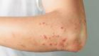 فرنسا ترصد مصابا بجدري القرود.. لم يسافر لأي دولة