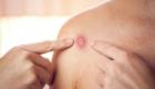 رصد أول إصابة بجدري القرود في إسرائيل