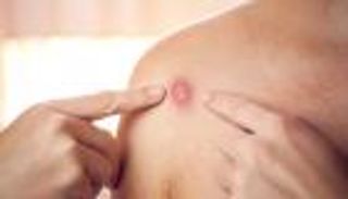 "جدري القرود" يصل أستراليا قادما من أوروبا