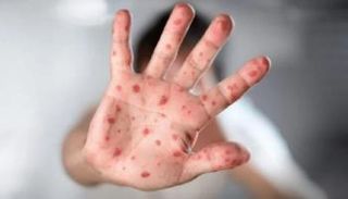 جدري القرود