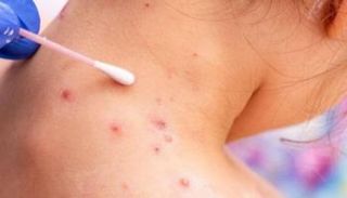 جدري القرود انطلق في أفريقيا وظهر في الولايات المتحدة وأوروبا