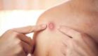  إصابة ثانية بجدري القرود في إسرائيل.. وفلسطين خالية