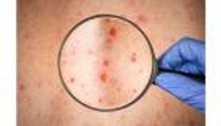 رسالة طمأنة من الصحة العالمية: خلو إقليم شرق المتوسط من إصابات جدري القرود