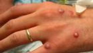 لأول مرة.. المغرب يسجل 3 حالات مشتبه في إصابتها بـ جدري القرود