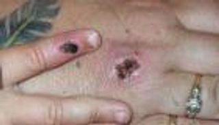 جدري القرود.. خبراء بريطانيا يطالبون مخالطي المرضى بالعزل 3 أسابيع