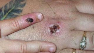 إصابة بجدري القردة - أرشيفية