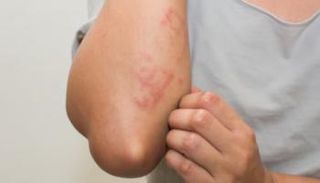 قلق عالمي متصاعد من جدري القرود