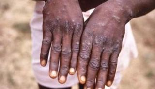 شخص مصاب بجدري القرود - أرشيفية