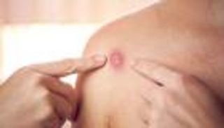 جدري القرود.. الصحة اليمنية تستنفر أطقمها وتنفي وجود إصابات