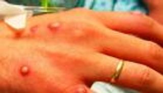 الإمارات تعلن رصد أول إصابة بجدري القرود لامرأة زائرة من غرب أفريقيا