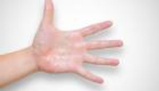 نصائح صيفية.. 5 علاجات منزلية للأيدي والأقدام المتعرقة