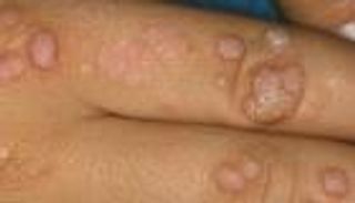 سلطنة عُمان تؤكد عدم رصد أي إصابة بمرض جدري القرود