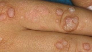 وزارة الصحة العمانية تعلن عدم رصد أي إصابة بجدري القرود