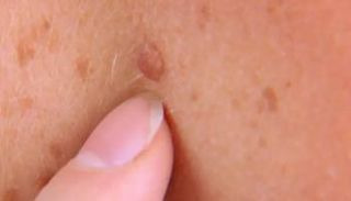 علامة على الإصابة بسرطان الجلد