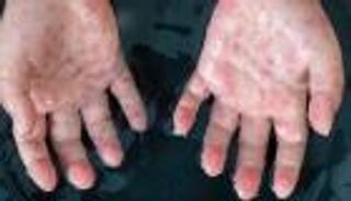 جدري القرود.. كندا ترصد 15 إصابة وتتوقع المزيد