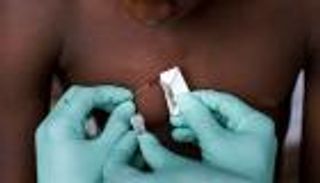 كندا تسجل 10 إصابات جديدة بجدري القرود