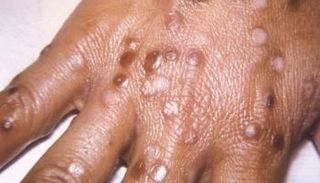 الطفح الجلدي أبرز أعراض جدري القرود