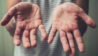 شخص مصاب بمرض جدري القرود