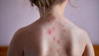 طفلة مصابة بالجدري المائي