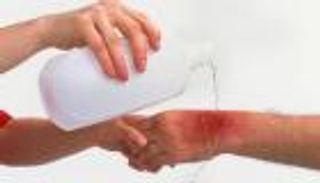 هل يفيد معجون الأسنان والثلج؟.. الطريقة المثالية للتعامل مع الحروق