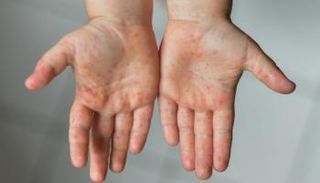 جدري القرود (صورة أرشيفية)