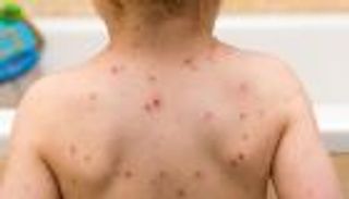 إصابات جدري القرود ترتفع لـ119 في البرتغال