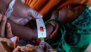  فحص طفل في الصومال تحسبا من سوء التغذية