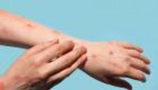 حانات المثليين والساونا.. بؤر انتشار جدري القرود في بريطانيا