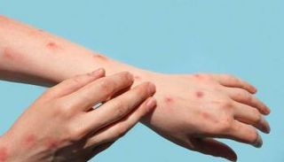 مريض بجدري القرود _ أرشيفية