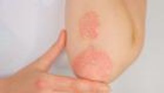 لمرضى الصدفية.. 5 أطعمة يجب تجنبها