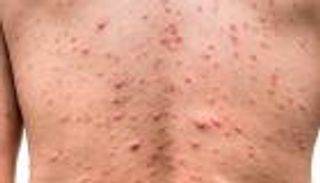 ألمانيا تسجل 113 إصابة بجدري القرود.. "رجال فقط"