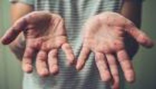 جدري القرود.. توصيات جديدة لمحاصرة المرض في إسبانيا