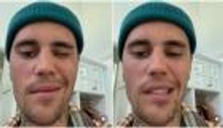 جاستن بيبر ومتلازمة رامزي هانت.. كل ما تريد معرفته عن "المرض الخطير"