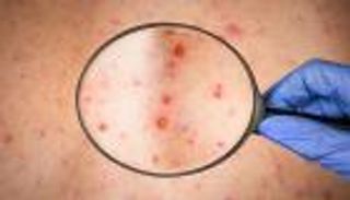 شهر على جدري القرود.. عرض غريب يظهر لأول مرة